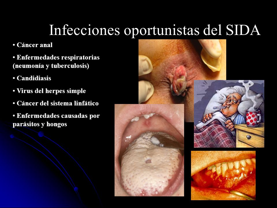 que son las enfermedades oportunistas del sida